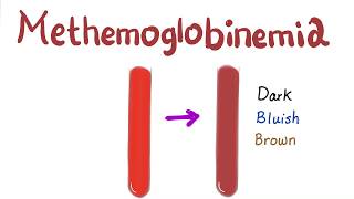 Methemoglobinemia [upl. by Hooke]