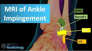 MRI of Anterolateral Ankle Impingement [upl. by Eednil]