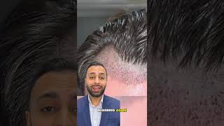 After Hair Transplant Timeline  Dr MediSpa [upl. by Ahseeyt]