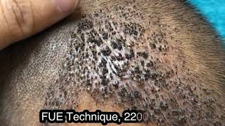 How scalp look after 10th day of Hair Transplant [upl. by Dunlavy459]