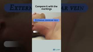 Examination of Jugular Venous Pulse [upl. by Nodnab26]