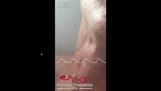 Jugular Venous Pulse Identification [upl. by Zuzana]