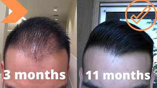 When To Expect Growth After A Hair Transplant My Timeline [upl. by Attiuqahs]