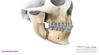 BSSO Mandibular Advancement [upl. by Aizek]