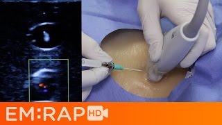 Rapid IJ aka Easy Internal Jugular Cannulation [upl. by Anyat]