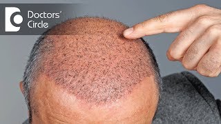 Side effects of Hair Transplant  Dr Vivekanand Bhat [upl. by Billat302]