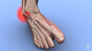 Heel Thrust Test  Posterior Ankle Impingement [upl. by Morez]