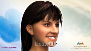 Malocclusion  Different Types [upl. by Diogenes284]