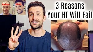 3 Reasons Your Hair Transplant Will FAIL [upl. by Raseda]