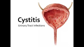 Cystitis lecture [upl. by Ahsenot]