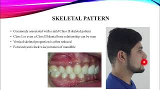 Class II Div 2 malocclusion [upl. by Alek802]