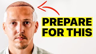 Hair Transplant  Everything You NEED To Know Before Surgery [upl. by Lemmuela272]