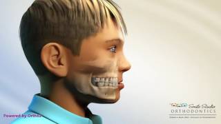 Facemask With Hyrax  Orthodontic Device [upl. by Demmahum750]