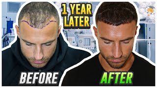 My Hair Transplant Results After 1 Year [upl. by Arba]