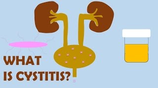 What is Cystitis [upl. by Aman]