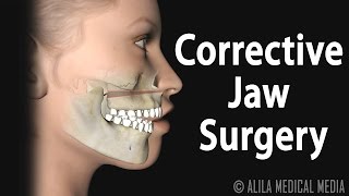 Corrective Jaw Orthognathic Surgery Animation [upl. by Novelia]