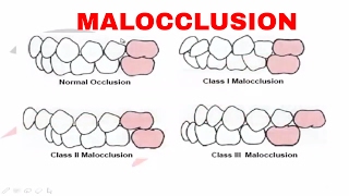 Malocclusion  Part I [upl. by Celina]