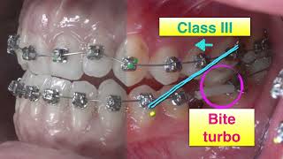 Class III Molar Protraction｜CC418 [upl. by Cordova]