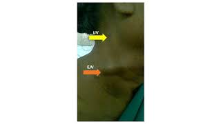 External and Internal Jugular vein pulsations [upl. by Lupe]