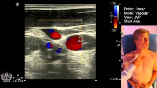 JVP Jugular Venous Pulsation Evaluation using Ultrasound [upl. by Layney]