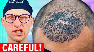 Hair Transplant Risks and Complications [upl. by Nylsirk622]