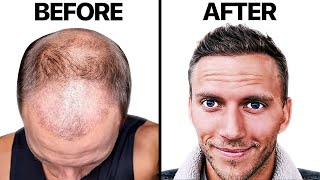 AWFUL Hair Transplant 4 Month RECOVERY  Hair Surgeon Reacts [upl. by Jalbert]