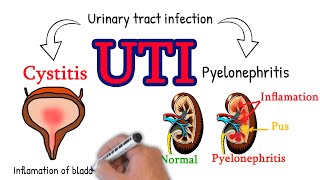 Interstitial Cystitis 101  Urology Care Podcast [upl. by Margi253]