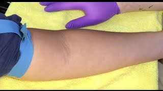 Tips For Locating Difficult Veins [upl. by Yddur539]